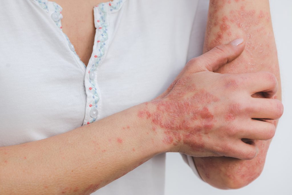 How To Treat Psoriasis