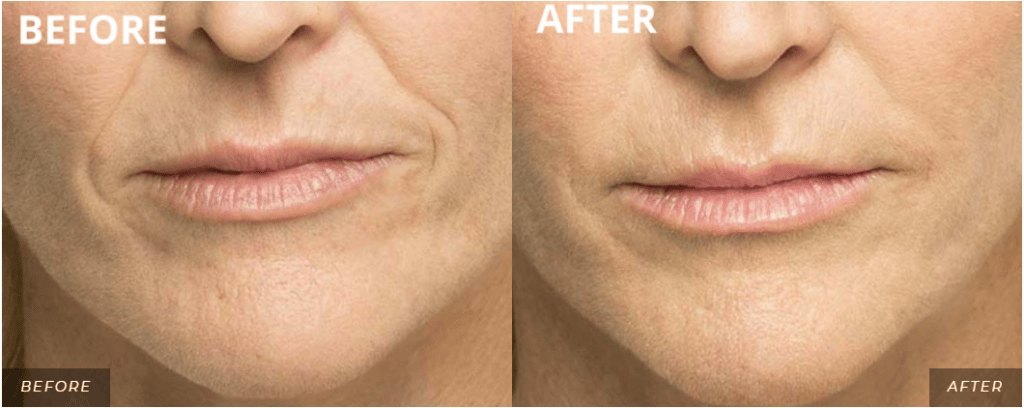 Before & After Photo of Belotero Balance Treatment