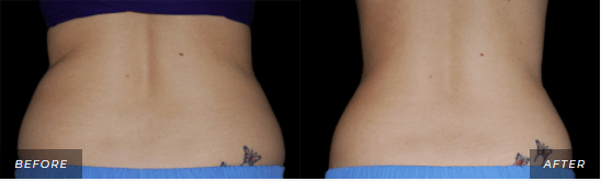 CoolSculpting Treatment Before and After Photos stomach 1