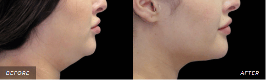 CoolSculpting Treatment Before and After Photos - Chin & jaw line