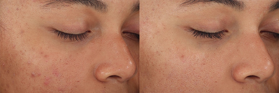 DiamondGlow Treatments Before and After Photos - After