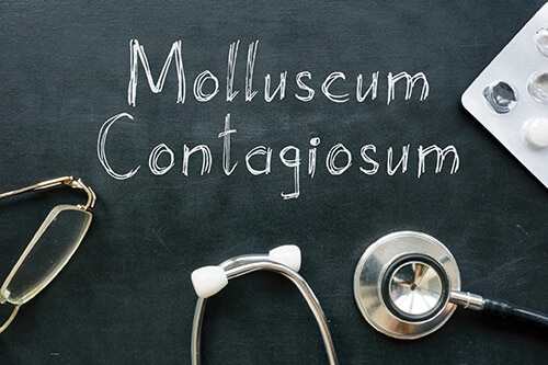 Molluscum Contagiosum