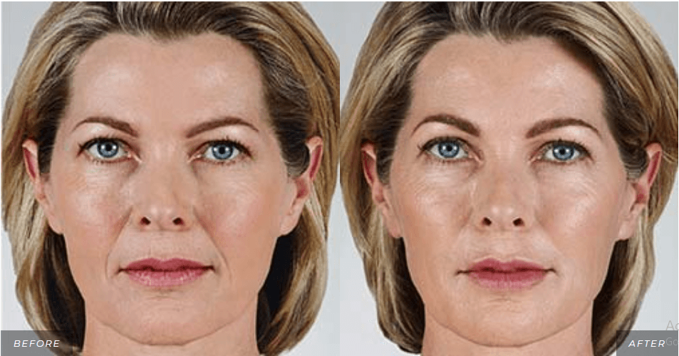 Woman Before and After Juvederm