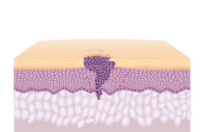 Illustration of Squamous Cell Carcinoma