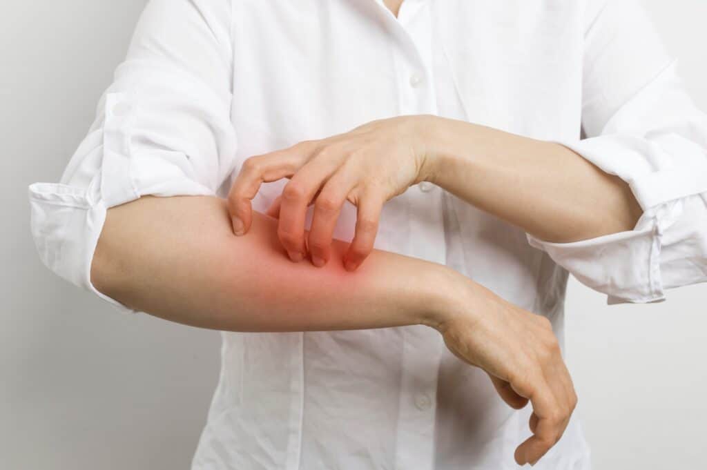 woman scratching her arm