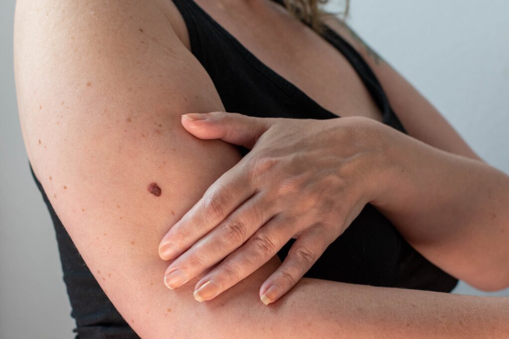 woman feeling a mole on her upper arm