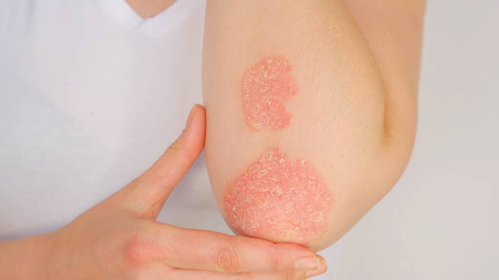 Psoriasis symptoms